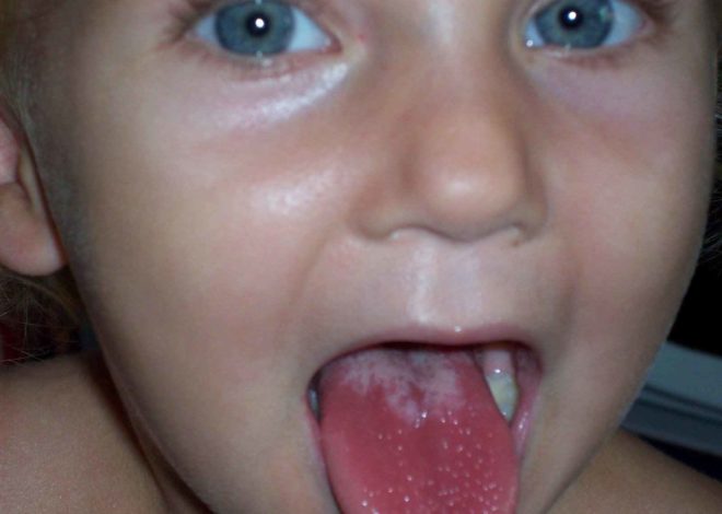 Прививки от скарлатины у детей в каком возрасте